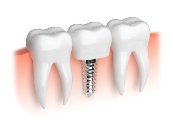 dental implants edinburgh